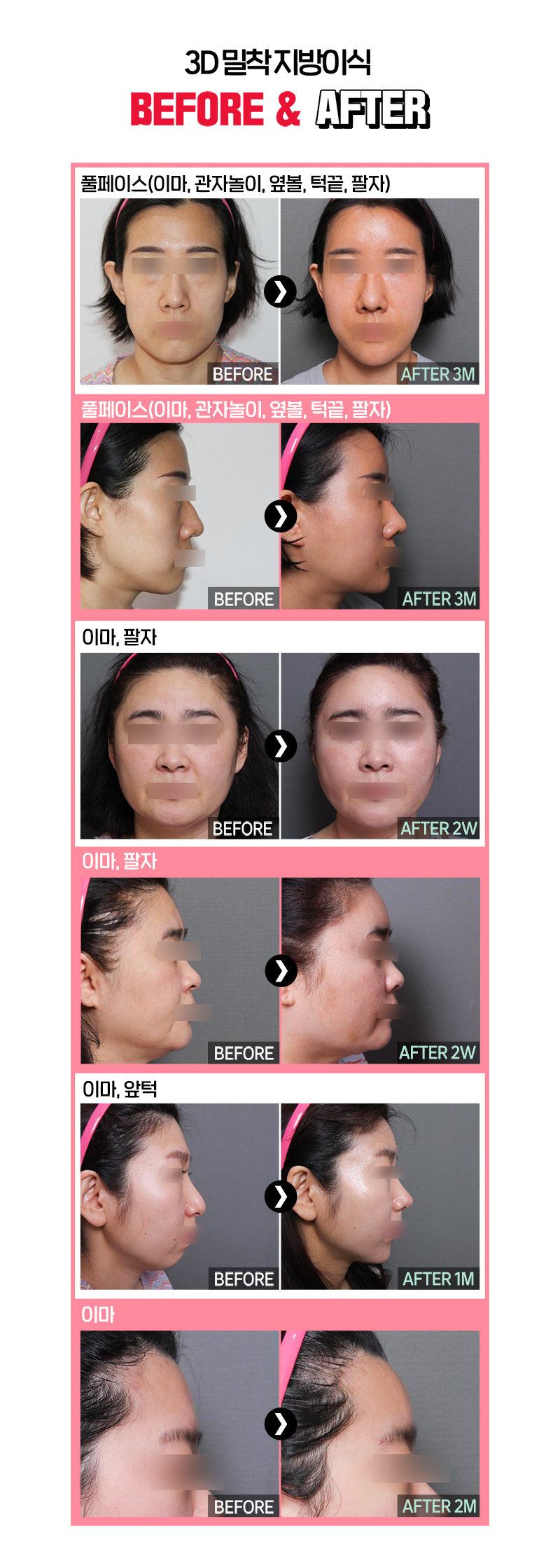디데이성형외과의원 디데이 3D 밀착 지방이식 이벤트, 시술 상세 이미지