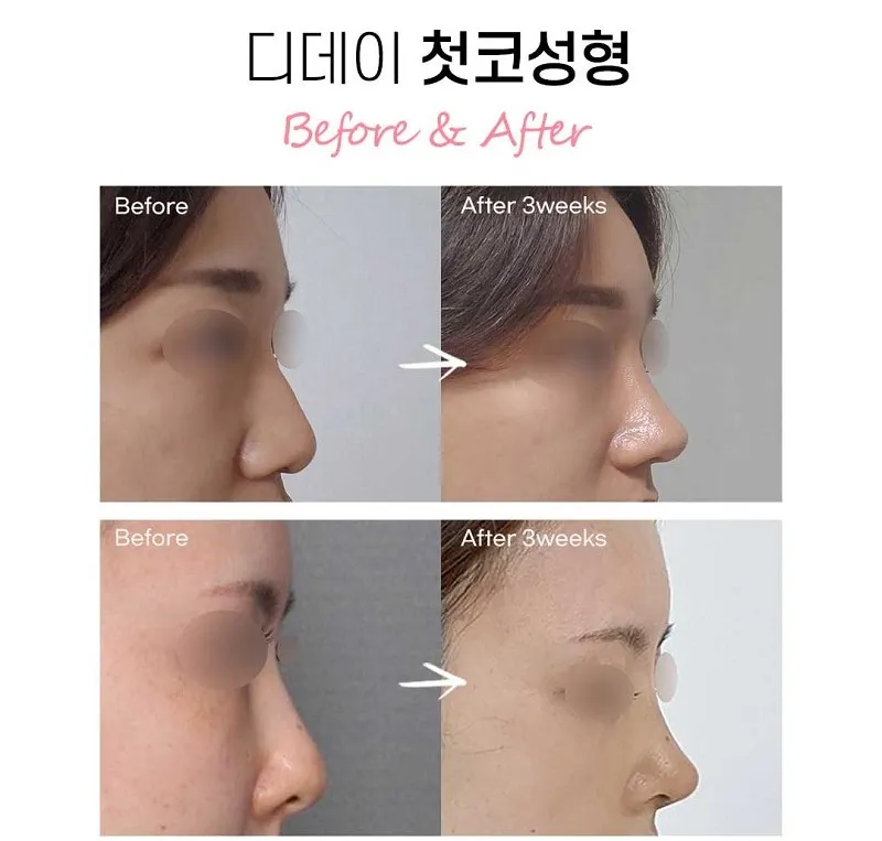 코라인은 디데이! 디데이 첫코성형!