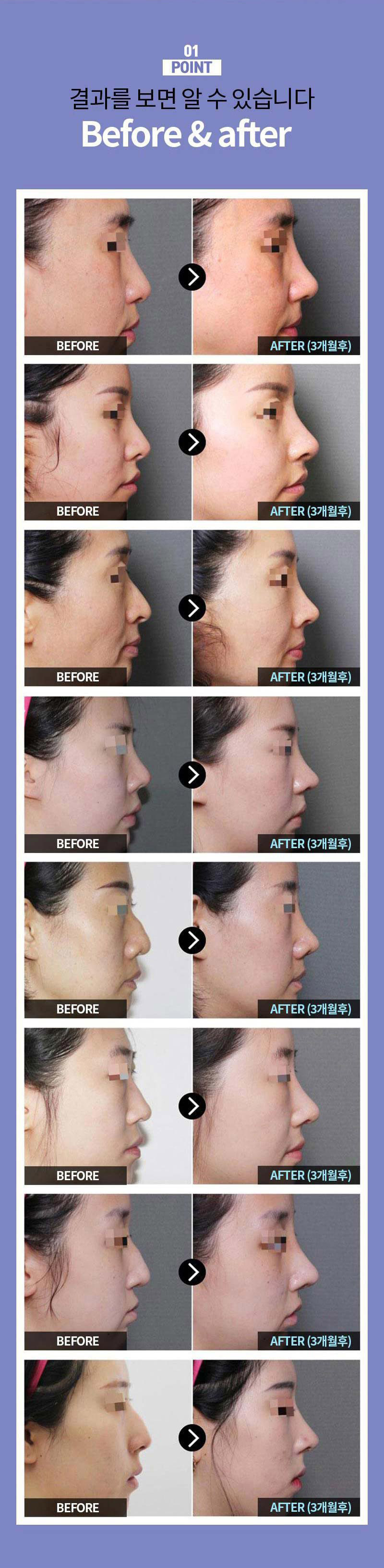 디데이성형외과의원 비염+미용 디데이 가벼운기능코 30 이벤트, 시술 상세 이미지