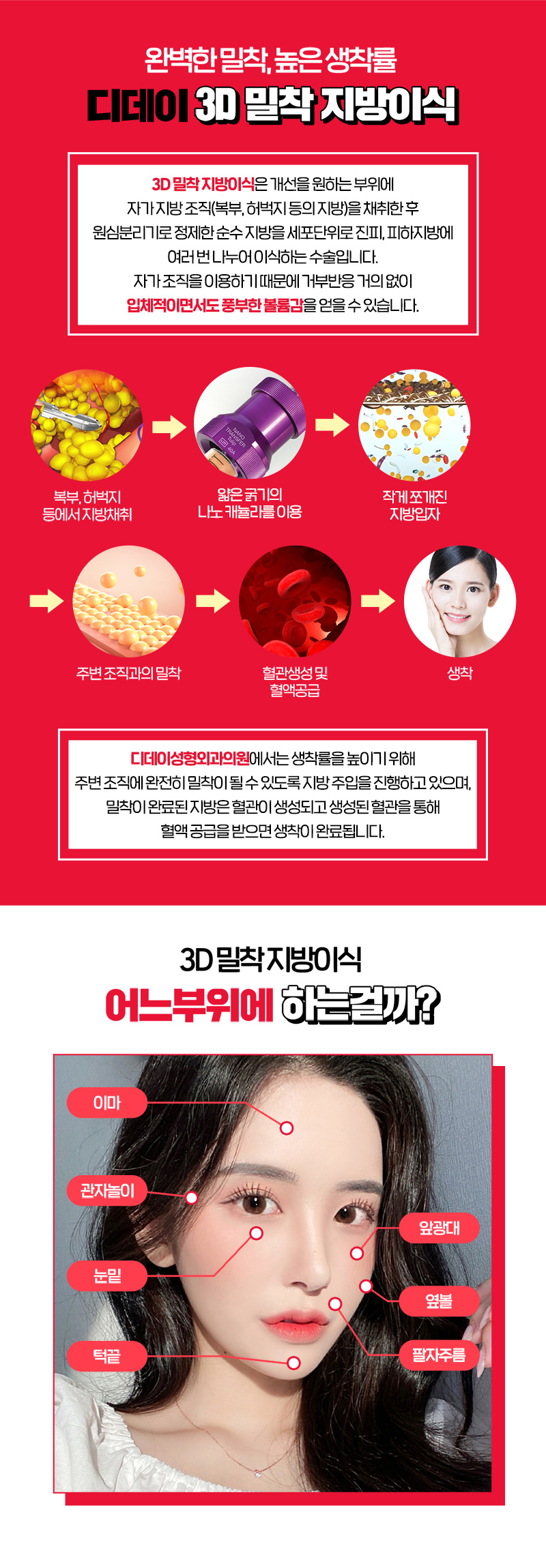 디데이성형외과의원 디데이 3D 밀착 지방이식 이벤트, 시술 상세 이미지