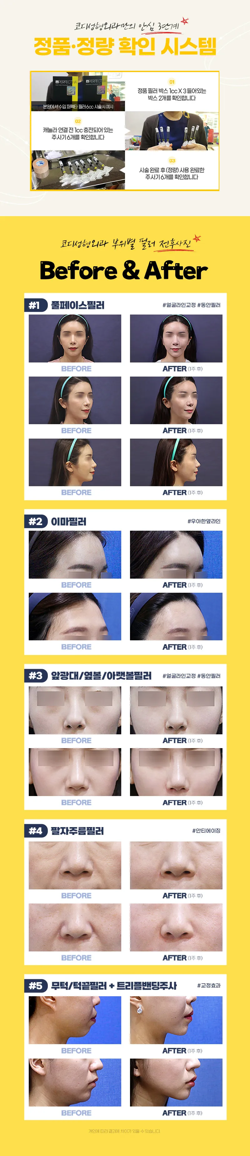 코디성형외과 코디 퍼펙타필러4cc 이벤트, 시술 상세 이미지