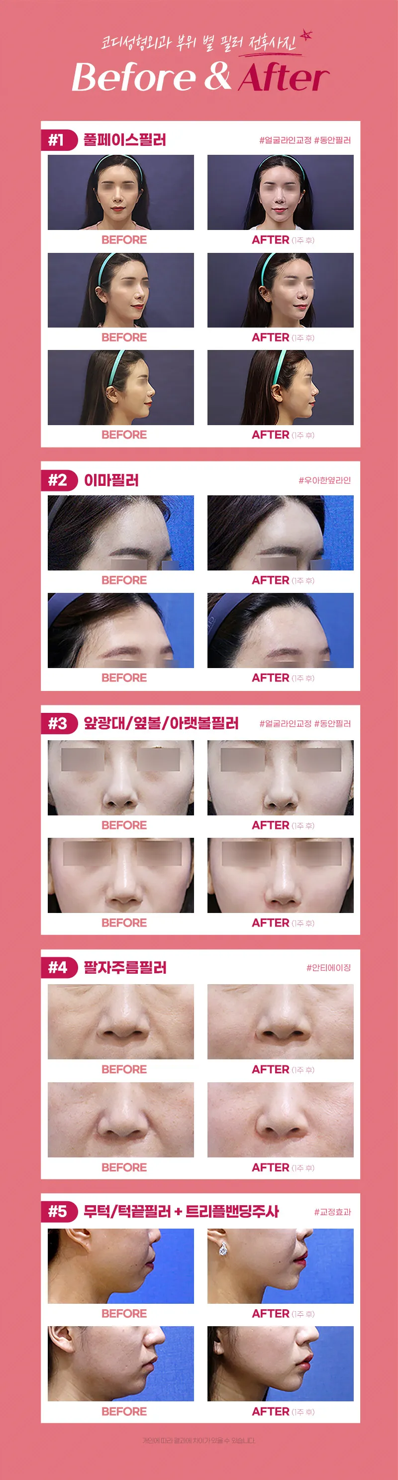 코디성형외과 풀페이스볼륨필러 1cc 5만원 이벤트, 시술 상세 이미지