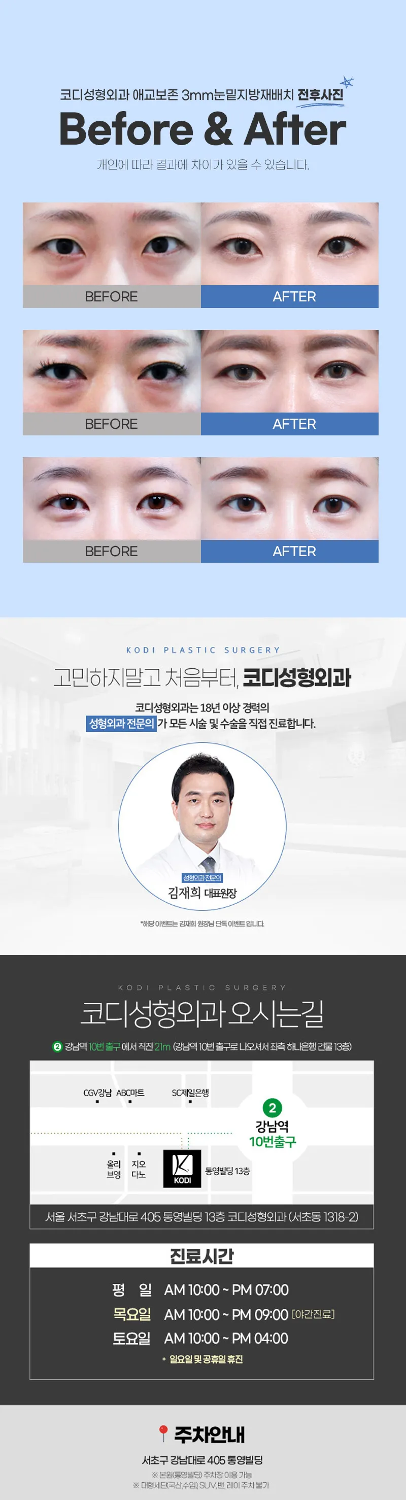 코디성형외과 애교보존 3mms눈밑지방재배치 이벤트, 시술 상세 이미지