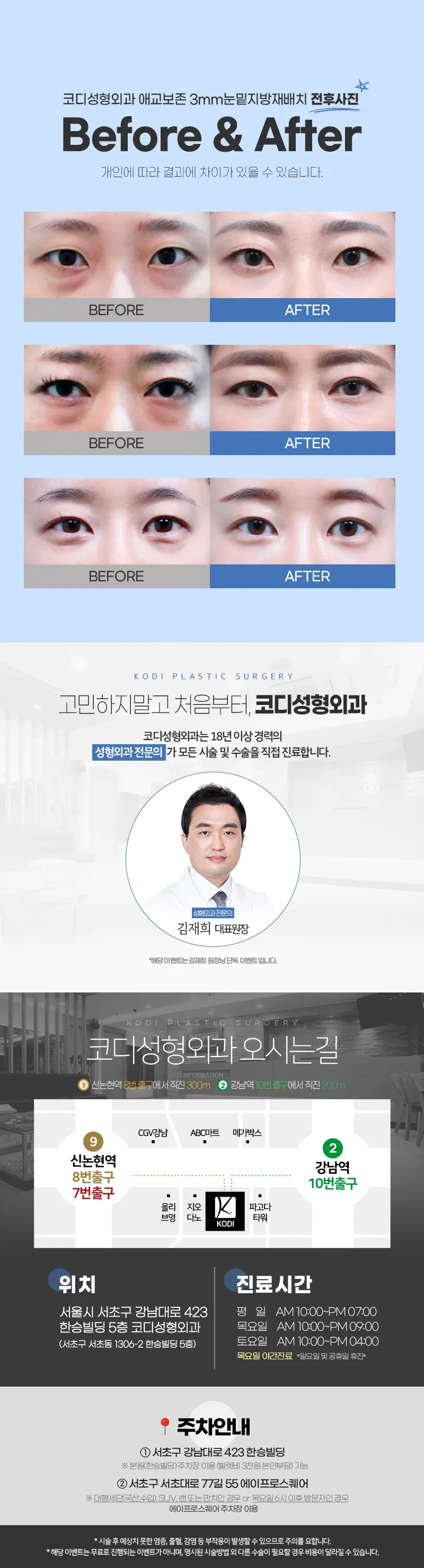 코디성형외과 애교보존 3mms눈밑지방재배치 이벤트, 시술 상세 이미지