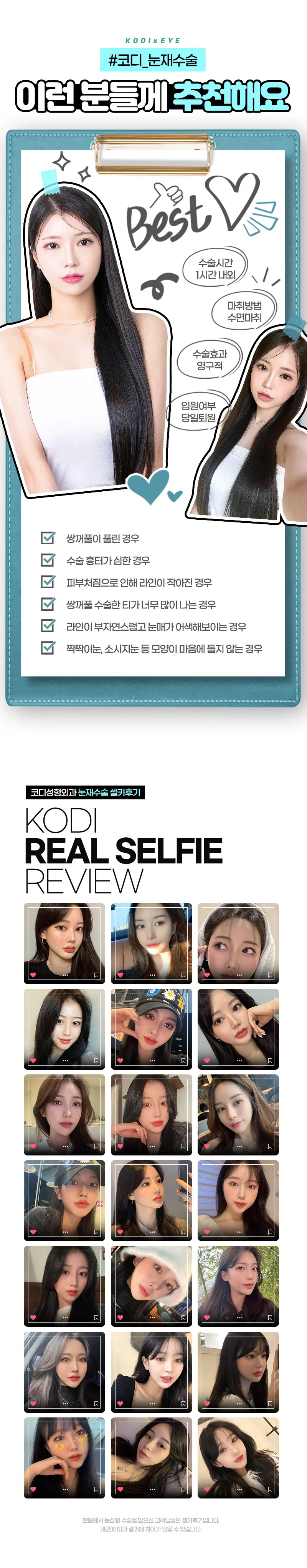 코디성형외과 코디★눈재수술 이벤트, 시술 상세 이미지