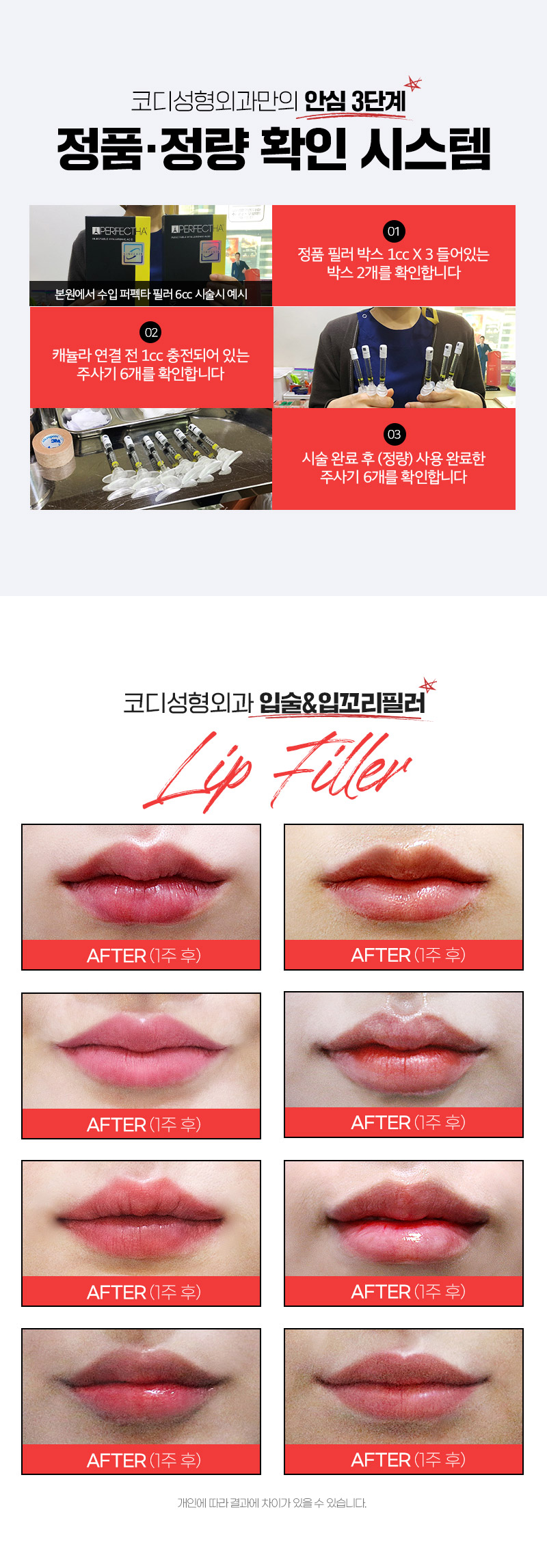 코디성형외과 ♡레스틸렌♡ 입술볼륨필러 이벤트, 시술 상세 이미지