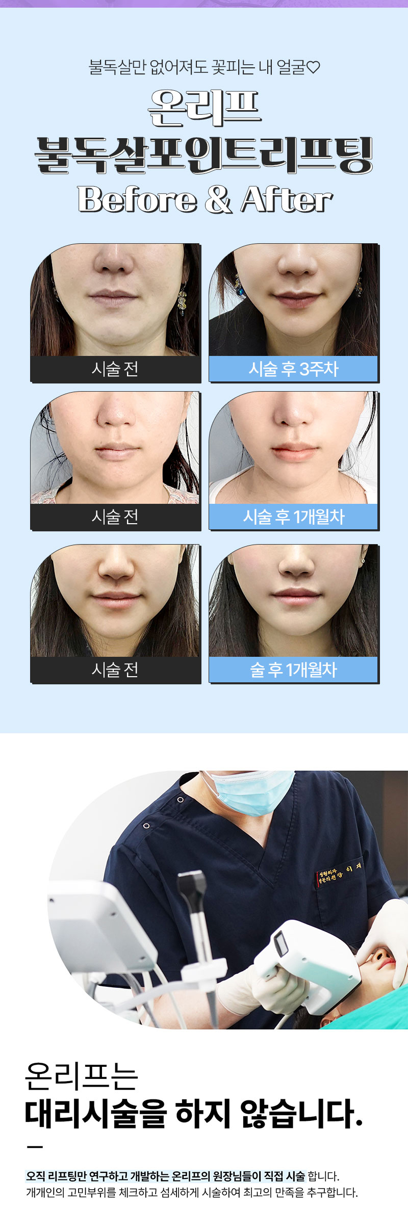 온리프성형외과 온리프 불독살 포인트 리프팅 이벤트, 시술 상세 이미지