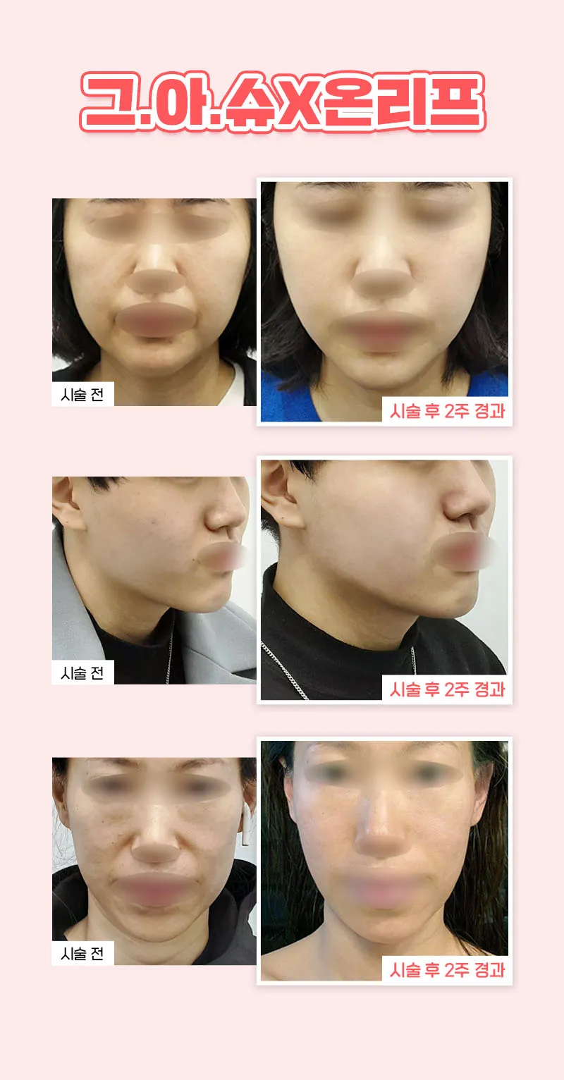 온리프성형외과 ★첫방문 이벤트★슈링크 리프팅 2만원 이벤트, 시술 상세 이미지