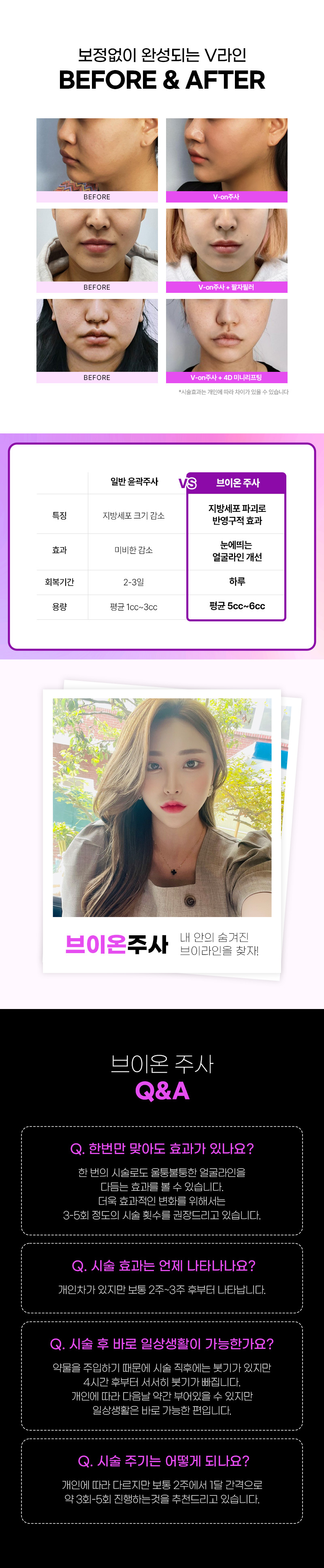 온리프성형외과 브이온 주사_윤곽주사 이벤트, 시술 상세 이미지