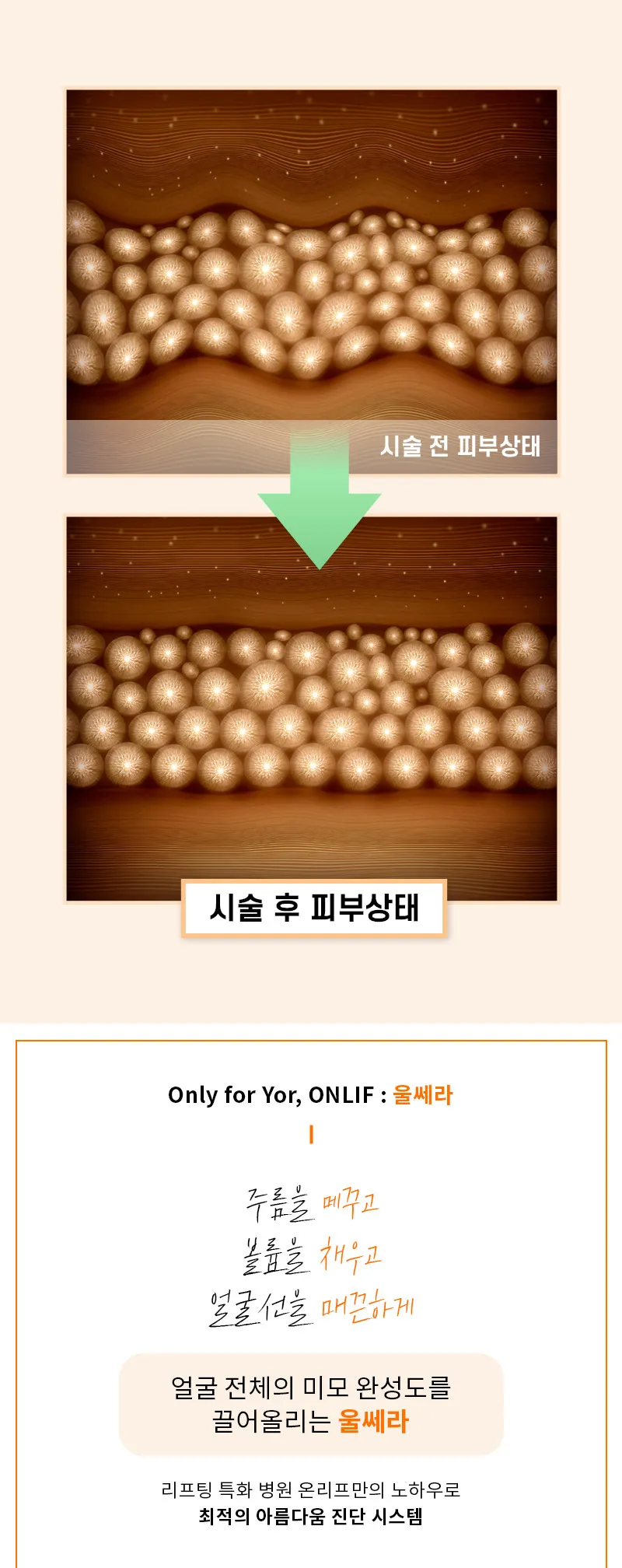 온리프성형외과 명불허전 울쎄라 리프팅 이벤트, 시술 상세 이미지