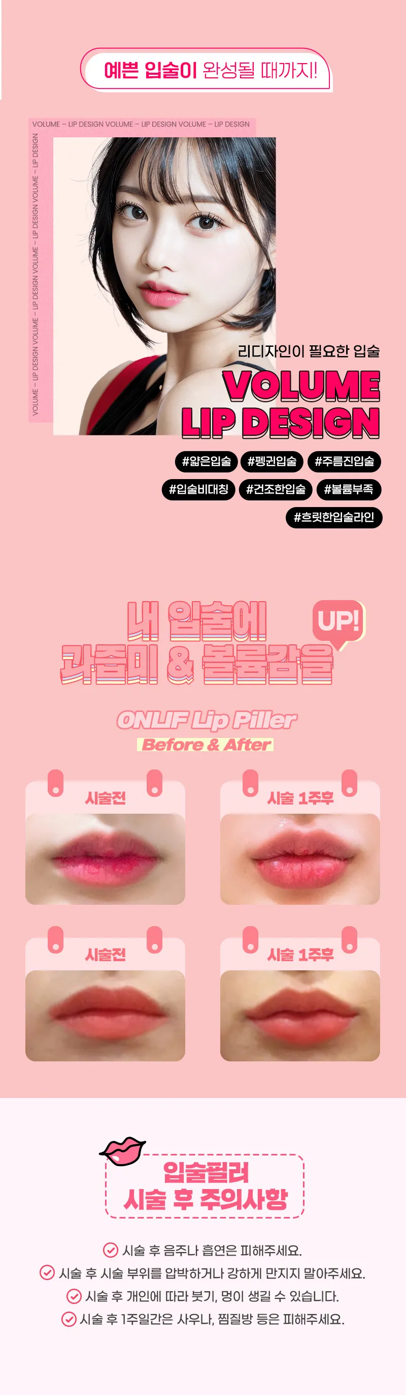 온리프성형외과 과즙톡톡 입술필러 이벤트, 시술 상세 이미지