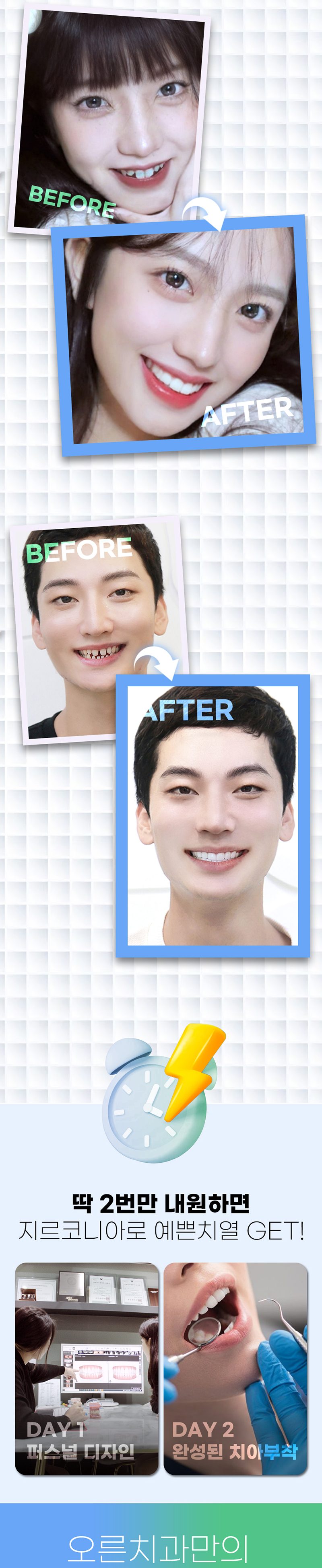 오른치과의원 튼튼하고 예쁜 지르코니아 앞니성형 이벤트, 시술 상세 이미지