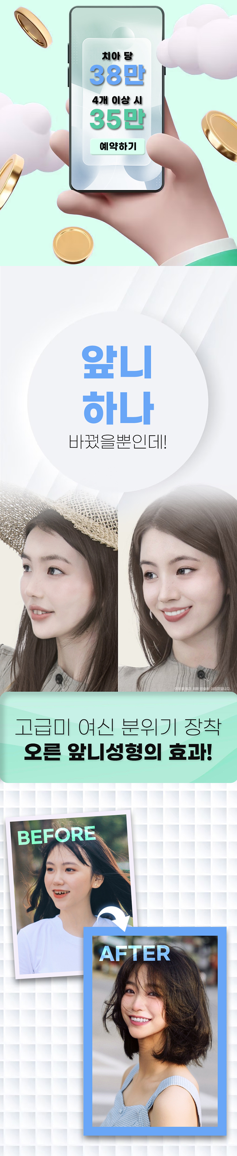 오른치과의원 튼튼하고 예쁜 지르코니아 앞니성형 이벤트, 시술 상세 이미지