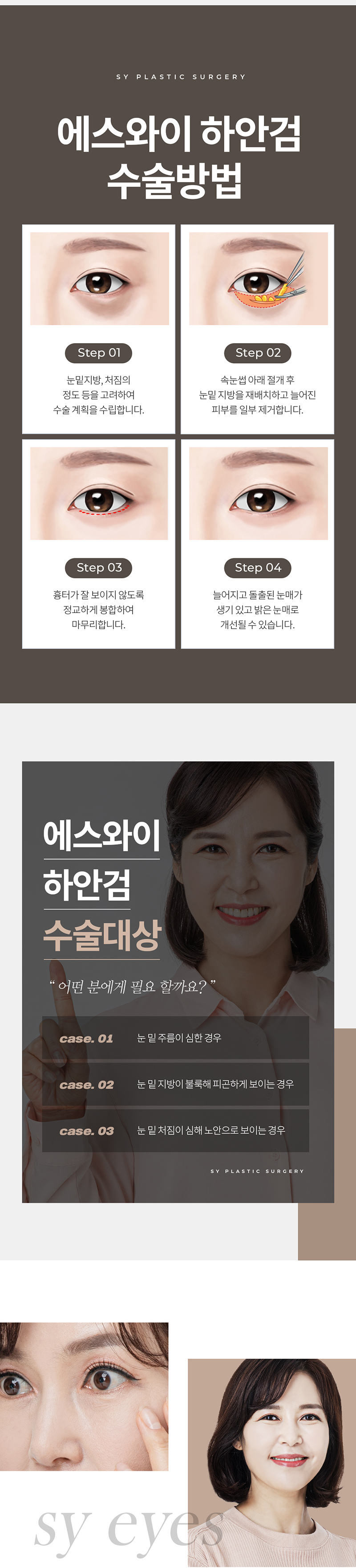 에스와이(SY)성형외과 중년 하안검수술 이벤트, 시술 상세 이미지