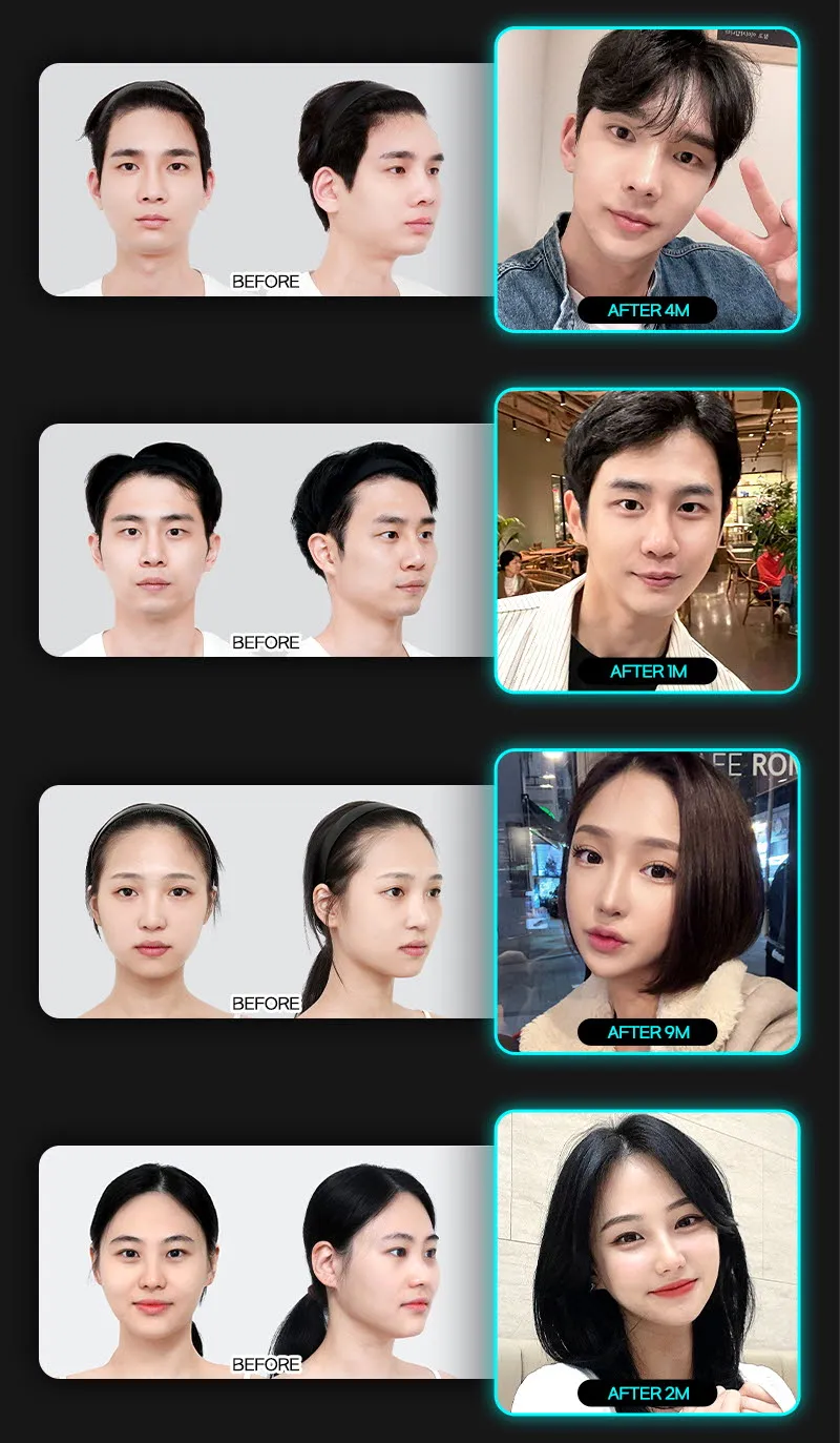 뷰성형외과 ❤️뷰❤️안면윤곽 이벤트, 시술 상세 이미지