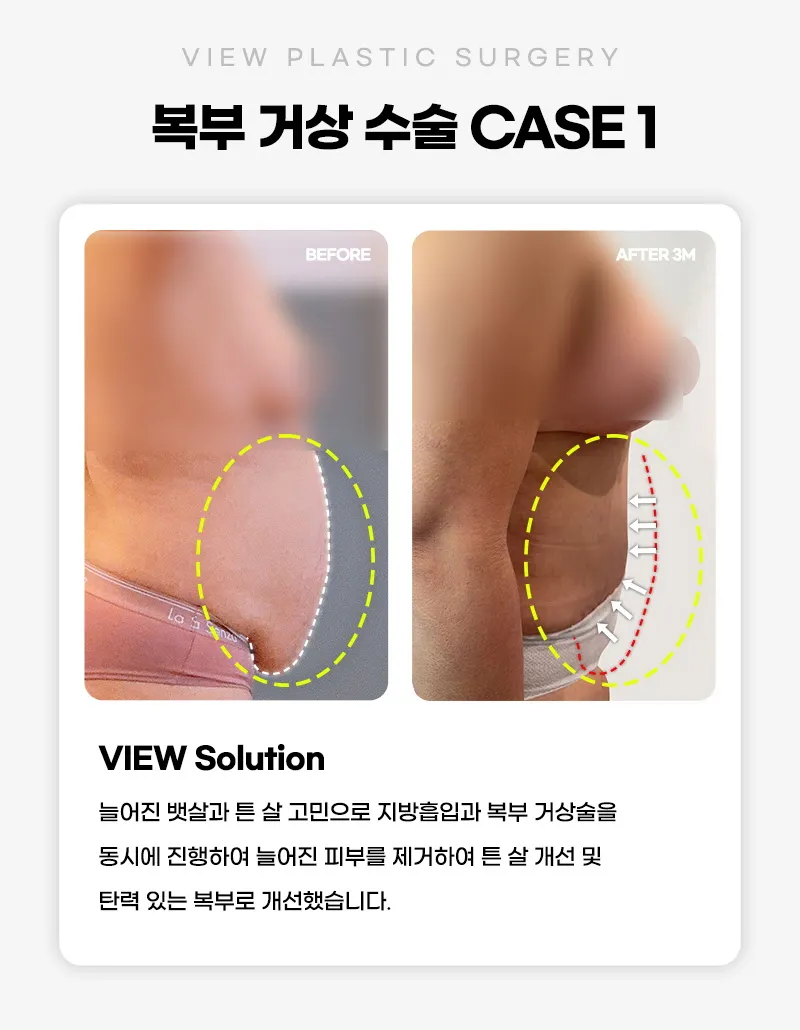 뷰성형외과 ❤뷰❤복부거상술 이벤트, 시술 상세 이미지