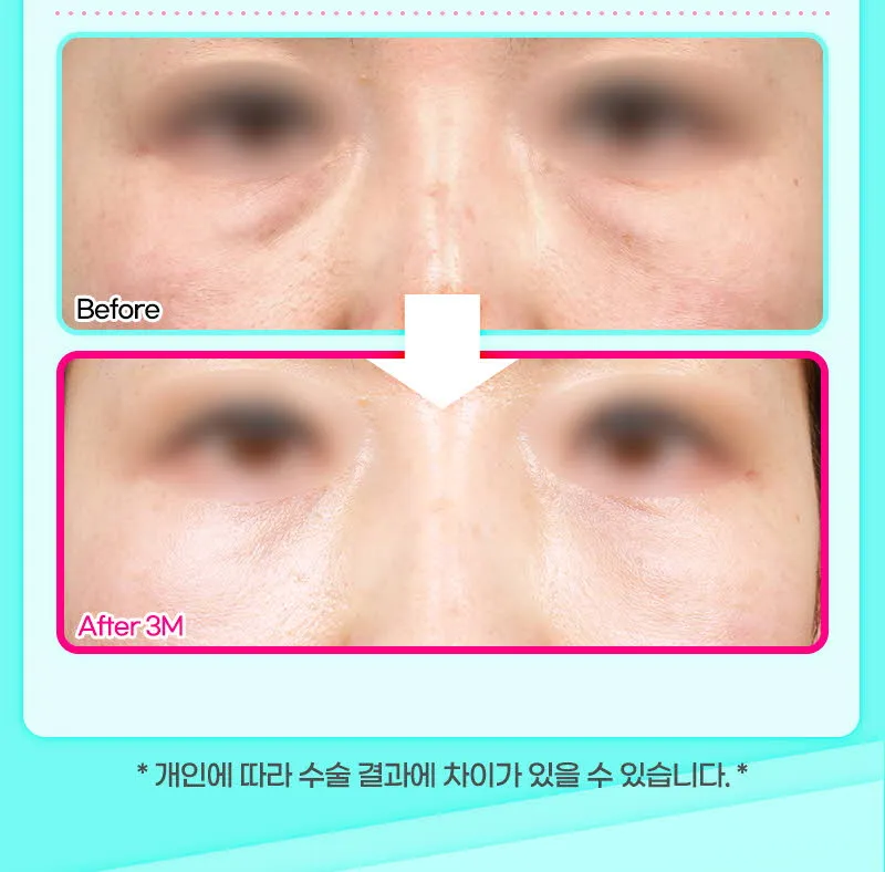 뷰성형외과 ❤️뷰❤️눈밑지방재배치 이벤트, 시술 상세 이미지