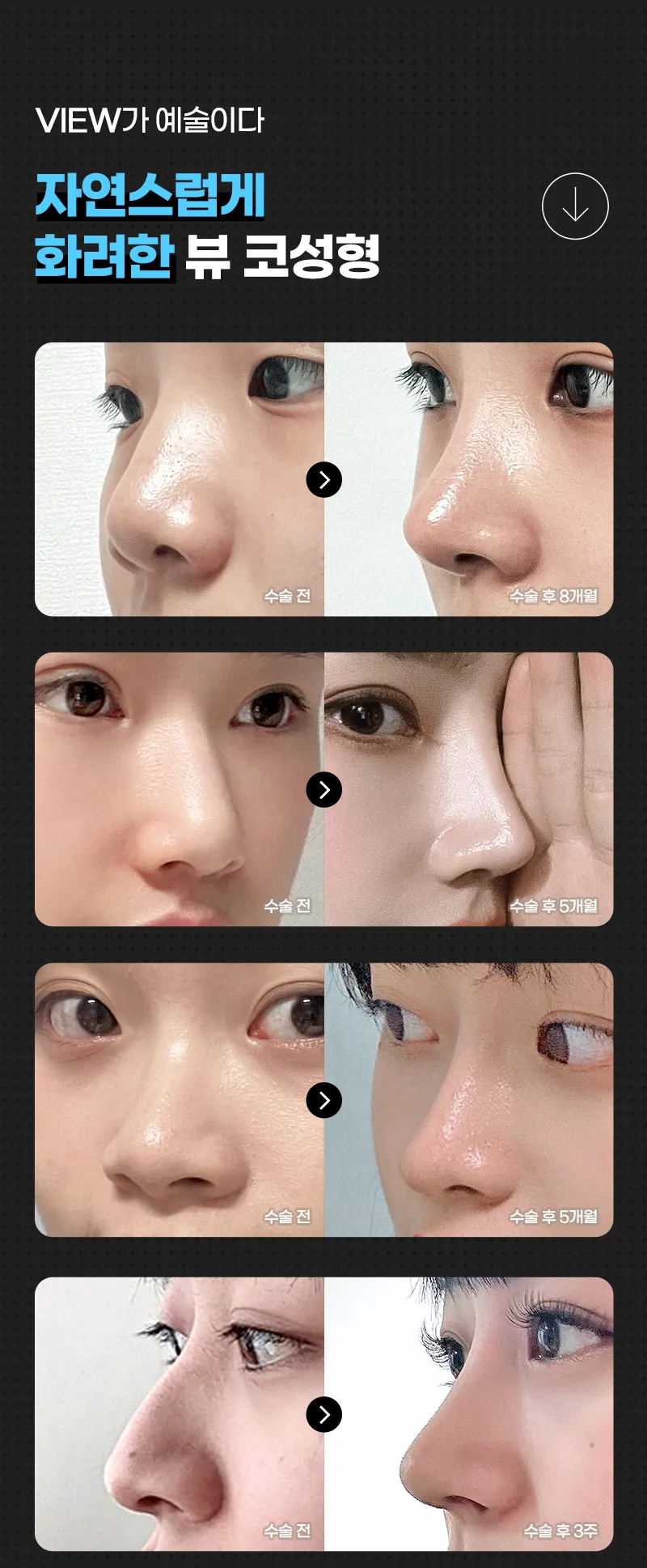 뷰성형외과 ❤️뷰❤️코성형 이벤트, 시술 상세 이미지