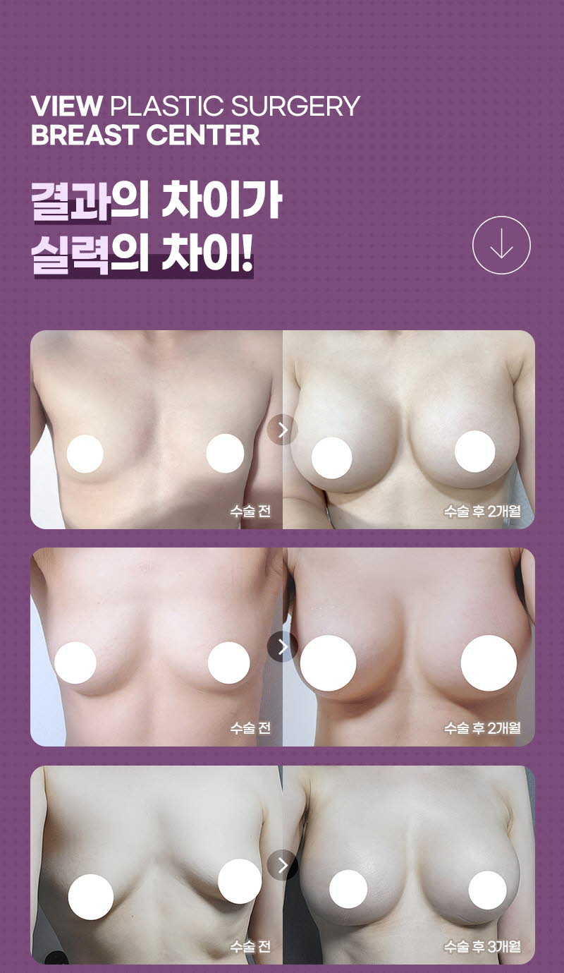 뷰성형외과 ❤️뷰❤️ 모티바 가슴성형 이벤트, 시술 상세 이미지