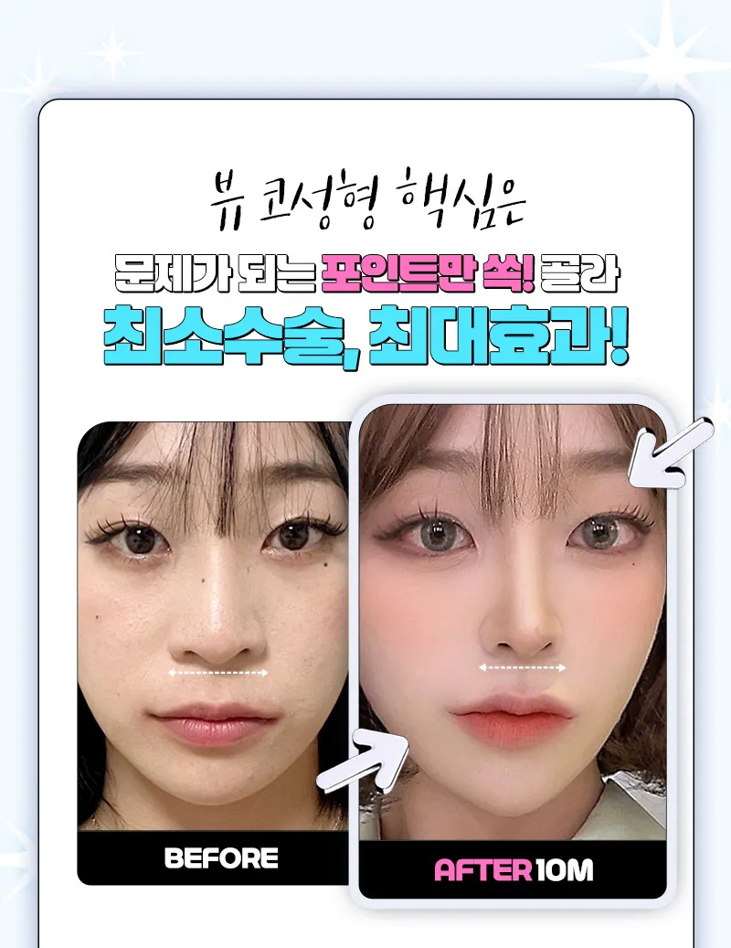 뷰성형외과 ❤️뷰❤️콧볼축소 이벤트, 시술 상세 이미지