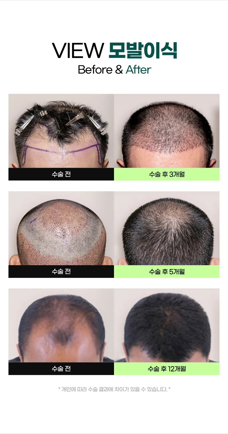 뷰성형외과 ❤뷰❤헤어라인 모발이식 이벤트, 시술 상세 이미지