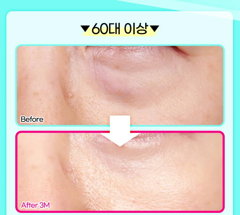 뷰성형외과 ❤️뷰❤️눈밑지방재배치 이벤트, 시술 상세 이미지