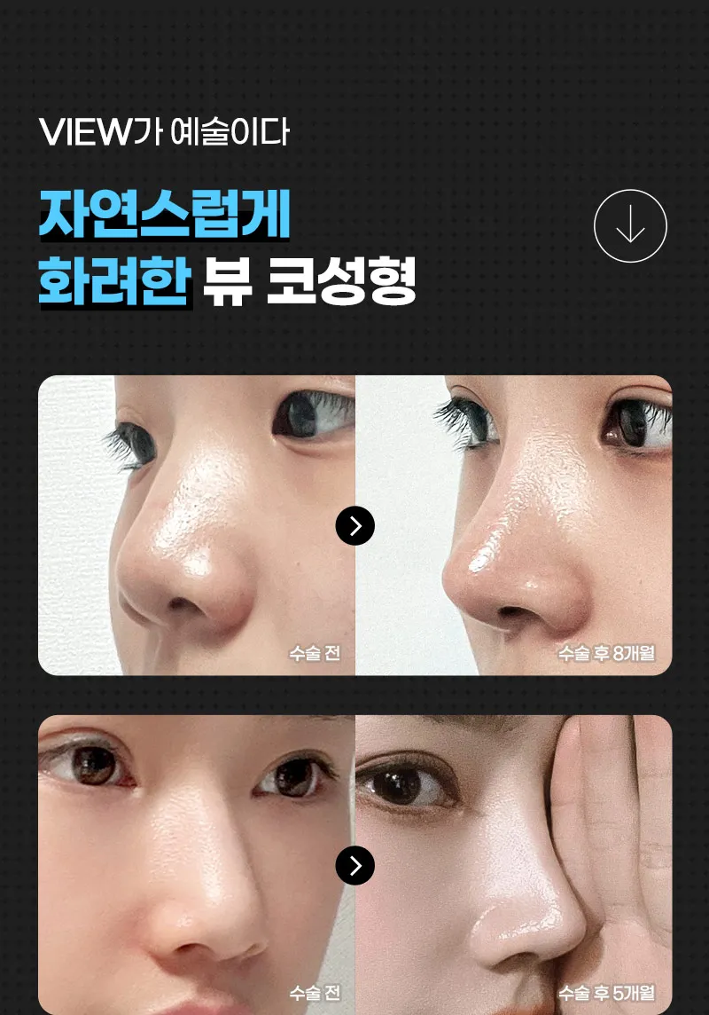 ❤️뷰❤️코성형