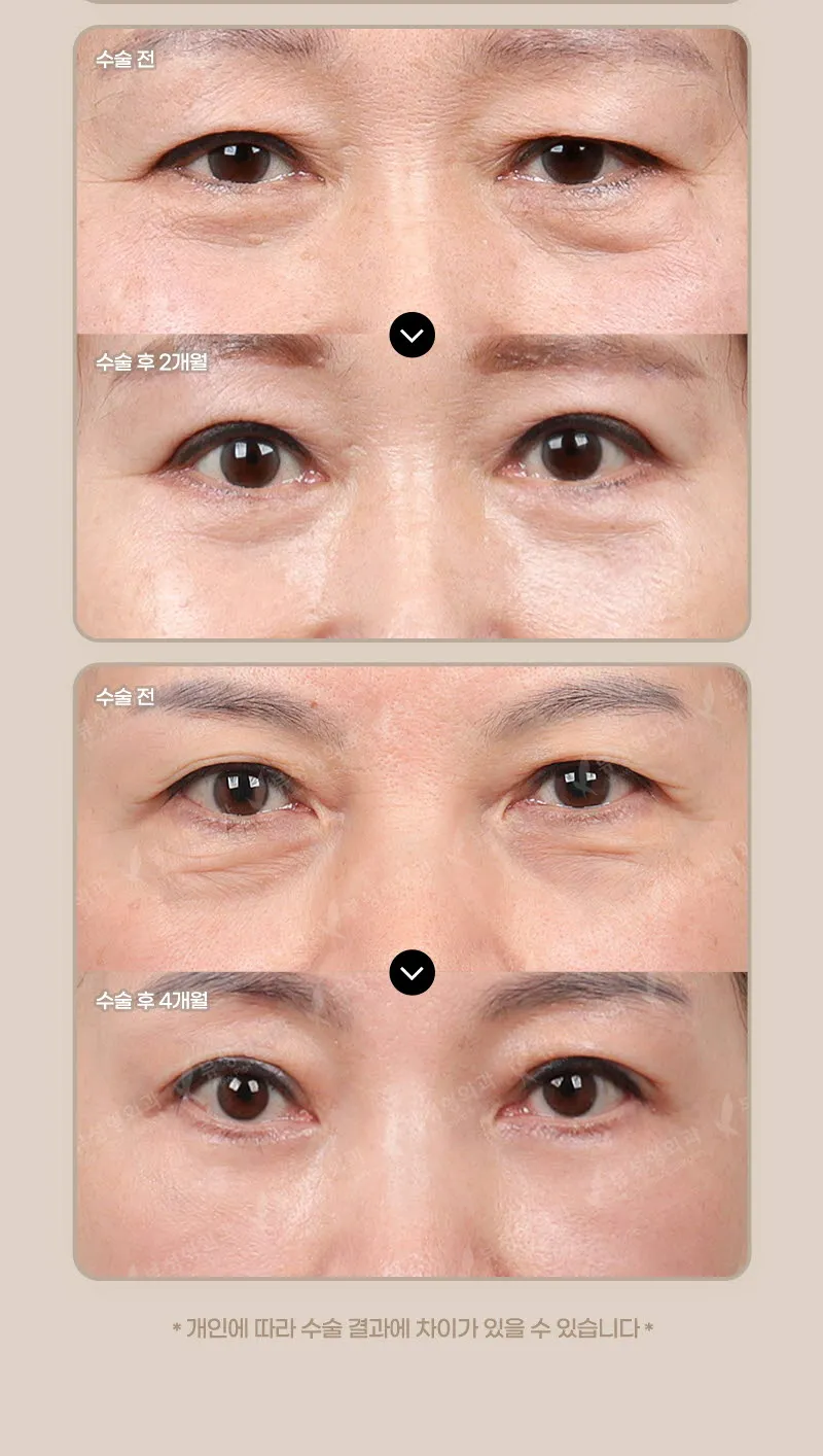 뷰성형외과 ❤️뷰❤️눈썹거상술 이벤트, 시술 상세 이미지