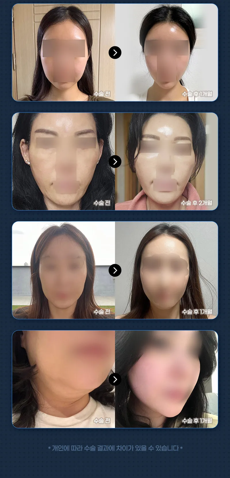 뷰성형외과 ❤️뷰❤️ 실리프팅 이벤트, 시술 상세 이미지