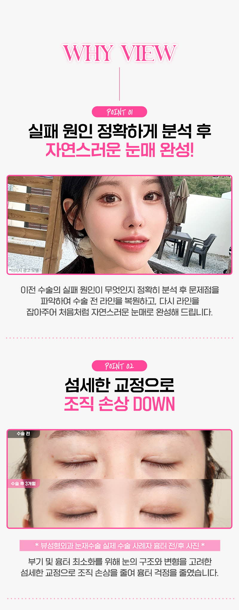 뷰성형외과 ❤️뷰❤️눈재수술 이벤트, 시술 상세 이미지