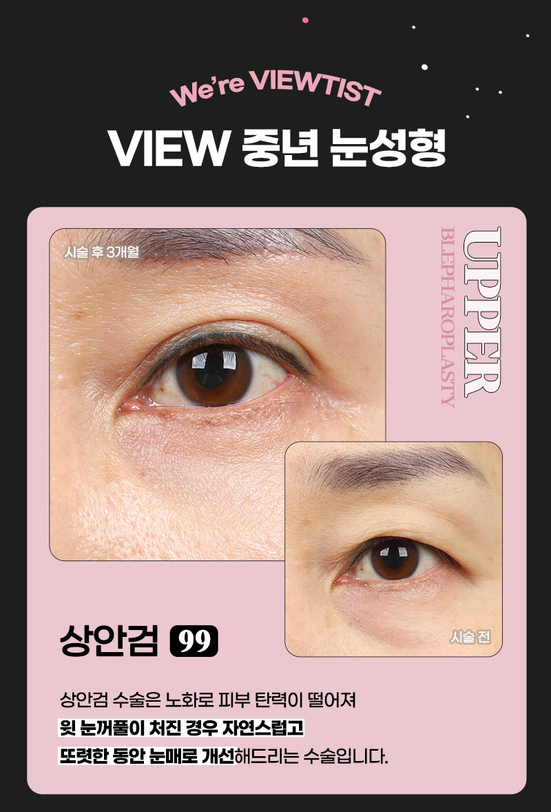 뷰성형외과 ❤️뷰❤️중년 눈성형 이벤트, 시술 상세 이미지
