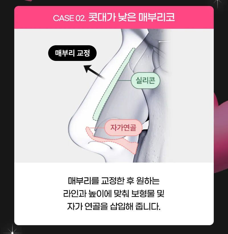 뷰성형외과 ❤️뷰❤️매부리코성형 이벤트, 시술 상세 이미지