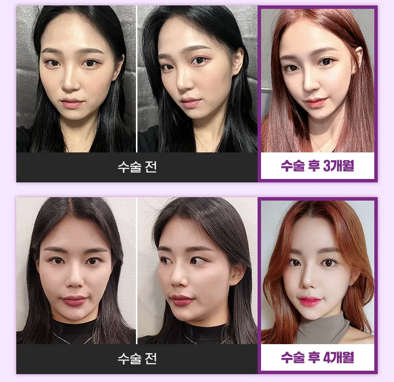 뷰성형외과 ❤️뷰❤️안면윤곽 재수술 이벤트, 시술 상세 이미지