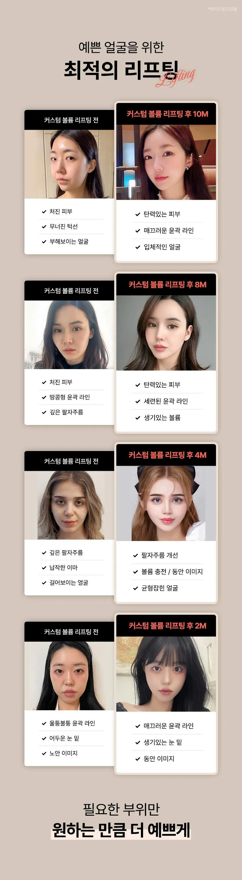 뷰성형외과 ❤뷰❤커스텀볼륨리프팅 이벤트, 시술 상세 이미지