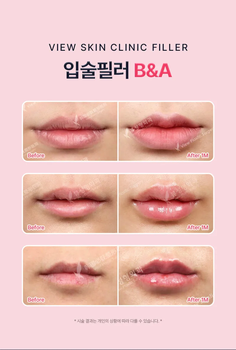 뷰성형외과 ❤뷰❤레스틸렌 입술필러, 입꼬리필러 이벤트, 시술 상세 이미지