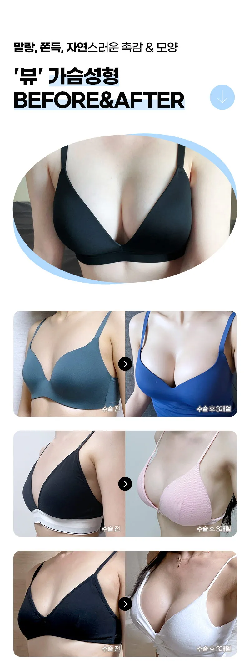 뷰성형외과 ❤️뷰❤️멘토 가슴성형 이벤트, 시술 상세 이미지