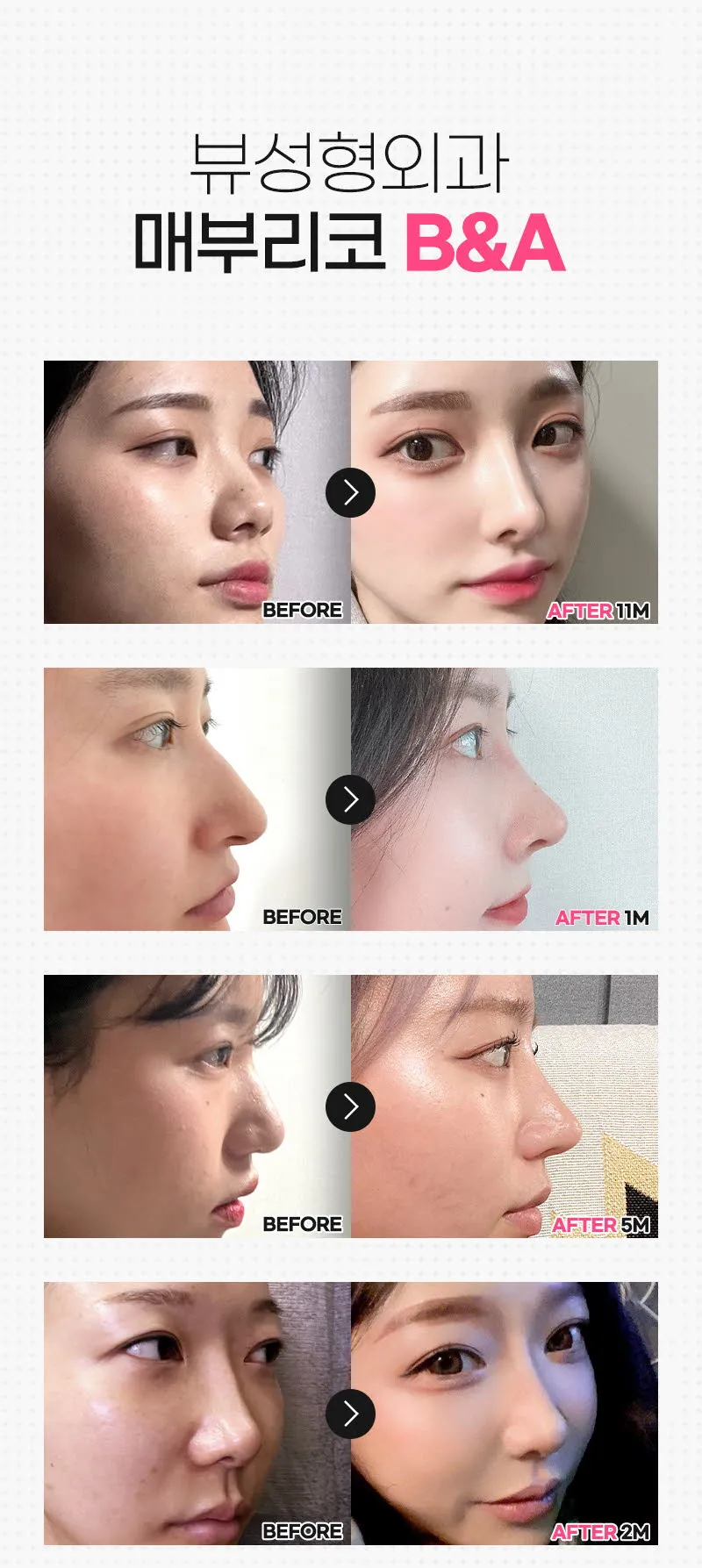 뷰성형외과 ❤️뷰❤️매부리코성형 이벤트, 시술 상세 이미지