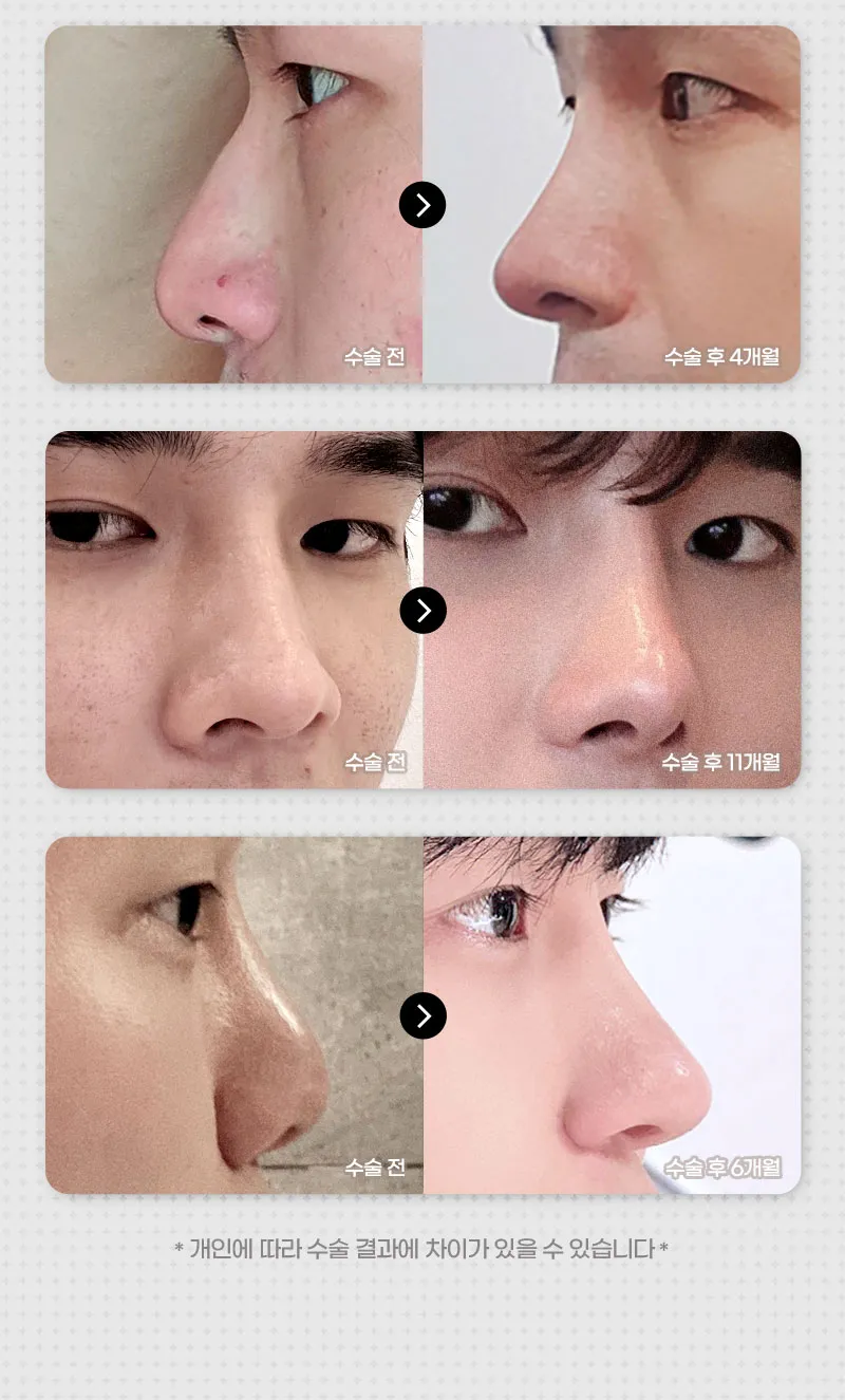 뷰성형외과 ❤️뷰❤️코재수술 이벤트, 시술 상세 이미지