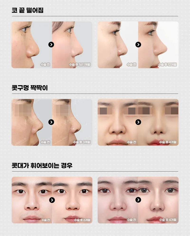 뷰성형외과 ❤️뷰❤️코재수술 이벤트, 시술 상세 이미지