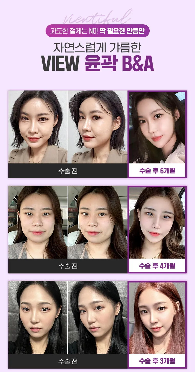 뷰성형외과 ❤️뷰❤️안면윤곽 재수술 이벤트, 시술 상세 이미지