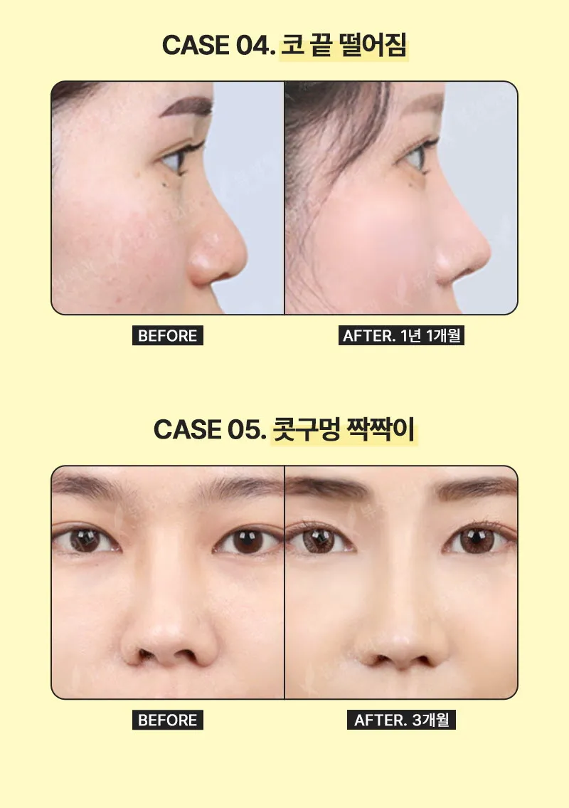 뷰성형외과 ❤️뷰❤️코재수술 이벤트, 시술 상세 이미지