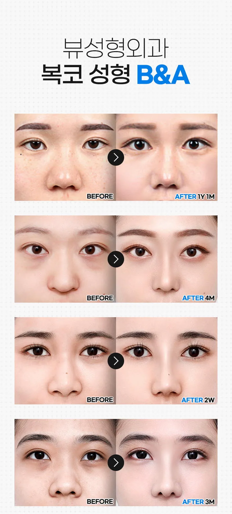 뷰성형외과 ❤️뷰❤️복코성형 이벤트, 시술 상세 이미지