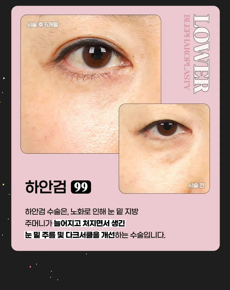 뷰성형외과 ❤️뷰❤️중년 눈성형 이벤트, 시술 상세 이미지