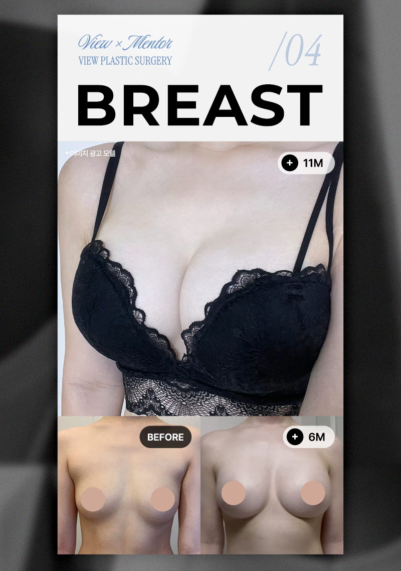 뷰성형외과 ❤️뷰❤️UIU 멘토 엑스트라 이벤트, 시술 상세 이미지