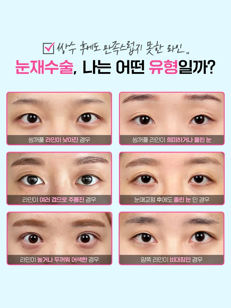 뷰성형외과 ❤️뷰❤️눈재수술 이벤트, 시술 상세 이미지