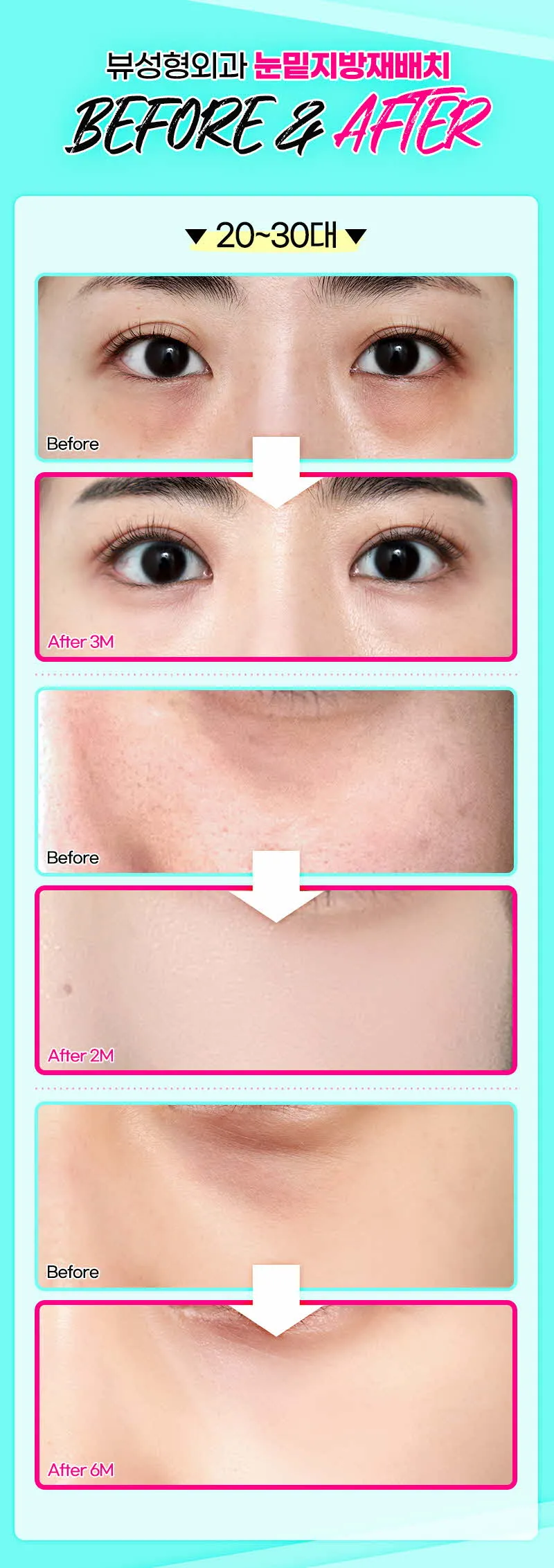 뷰성형외과 ❤️뷰❤️눈밑지방재배치 이벤트, 시술 상세 이미지