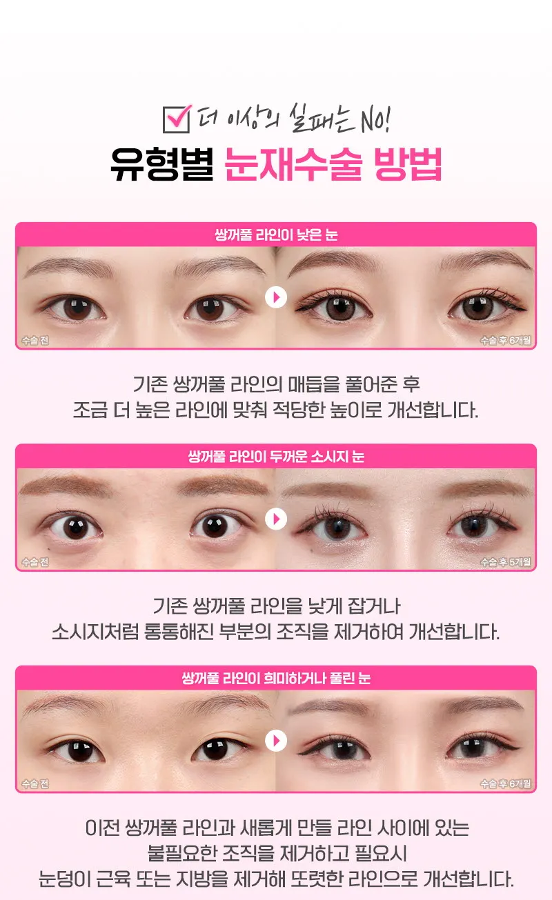 뷰성형외과 ❤️뷰❤️눈재수술 이벤트, 시술 상세 이미지