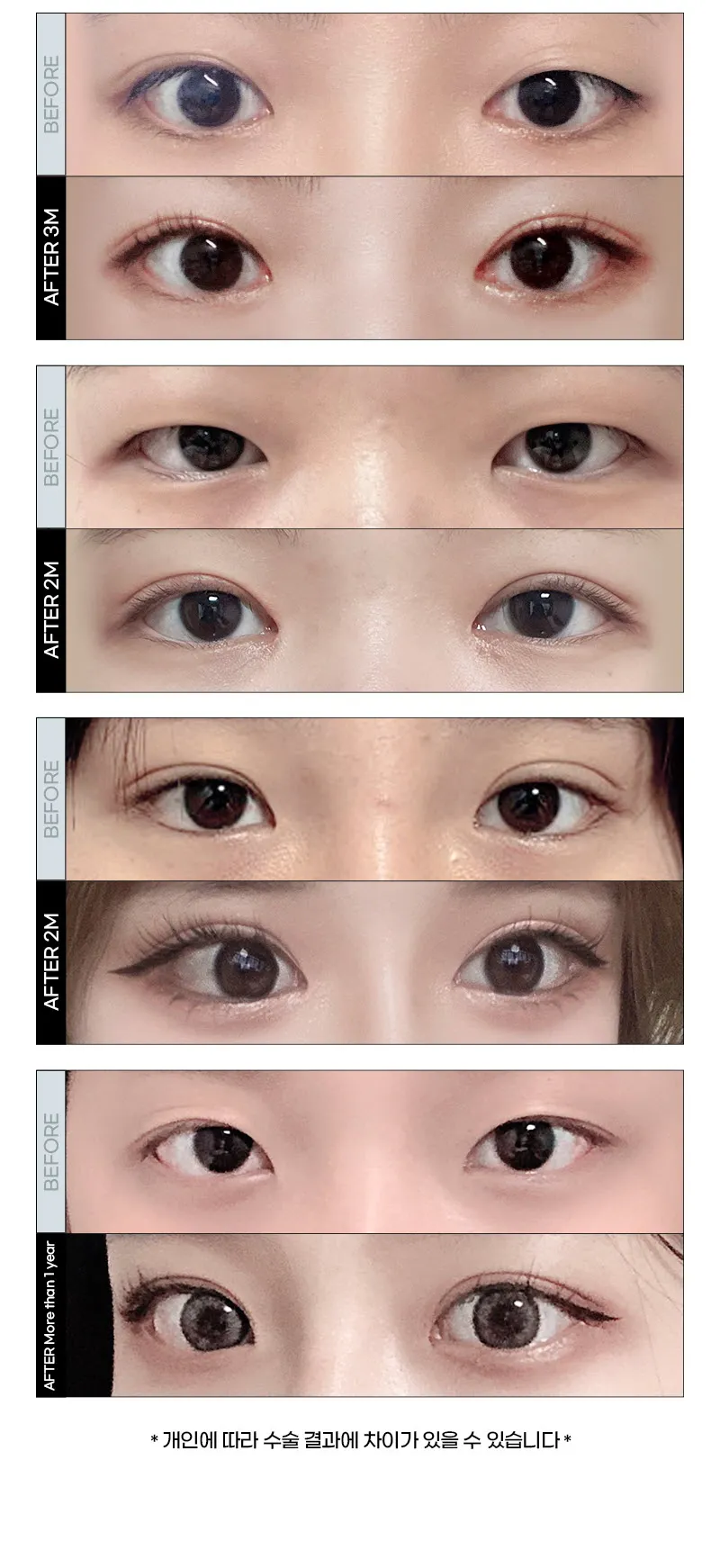 뷰성형외과 ❤️뷰❤️눈성형 이벤트, 시술 상세 이미지