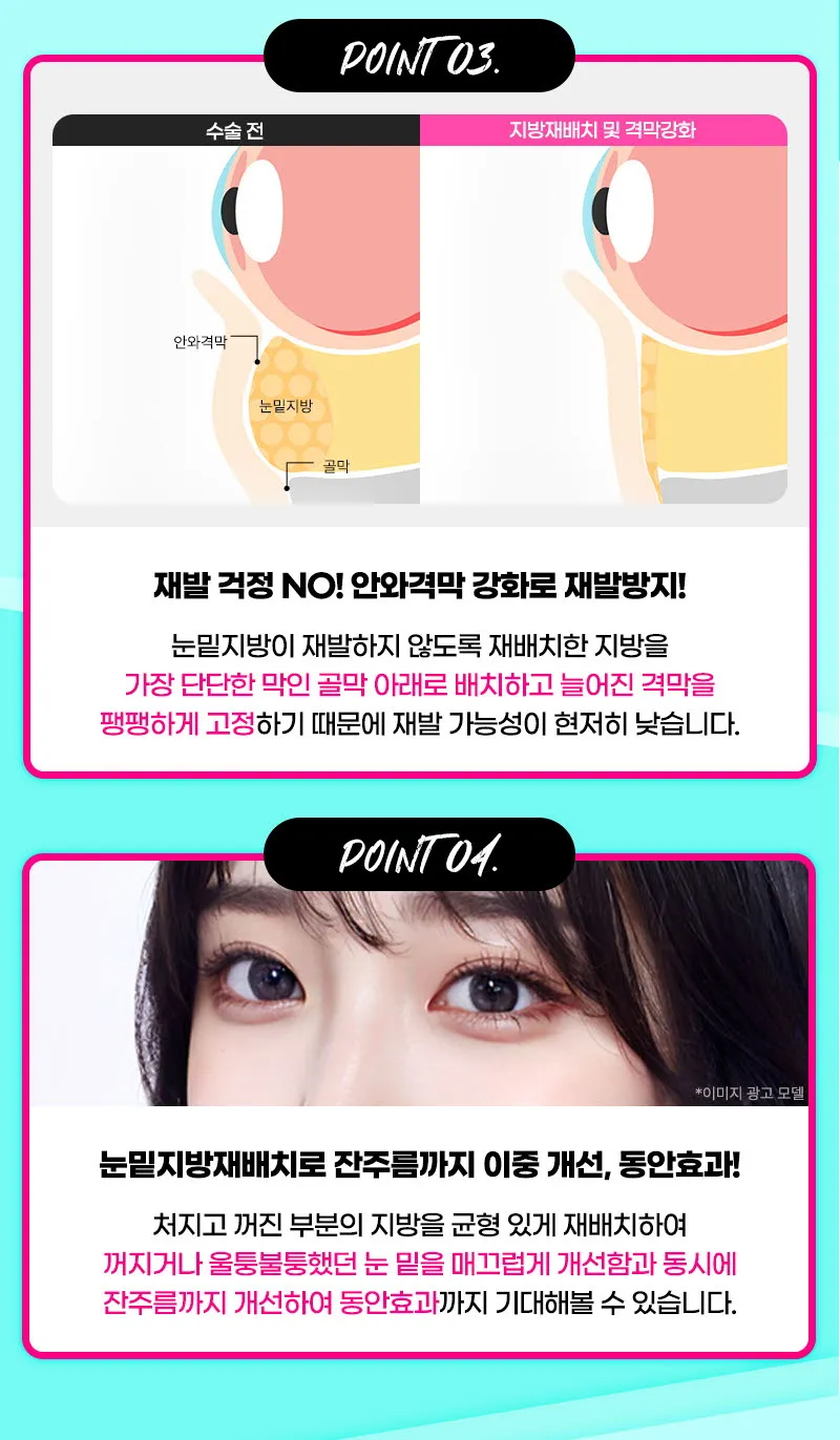 뷰성형외과 ❤️뷰❤️눈밑지방재배치 이벤트, 시술 상세 이미지