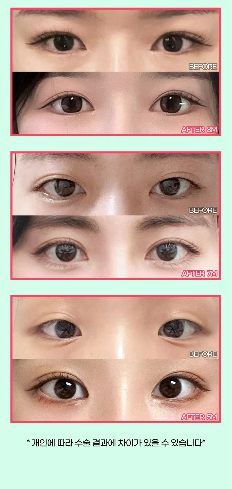 뷰성형외과 ❤️뷰❤️오픈 트임 이벤트, 시술 상세 이미지